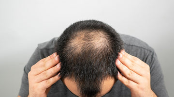 How To Take A Proactive Approach To Balding